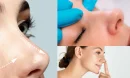 Preservation Rhinoplasty Kalıcı Sonuç Verir Mi?