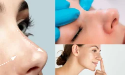 Preservation Rhinoplasty Kalıcı Sonuç Verir Mi?