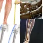 Limb Lengthening Uzuv Uzatma