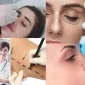 Ameliyatsız Yüz Germe Nedir?